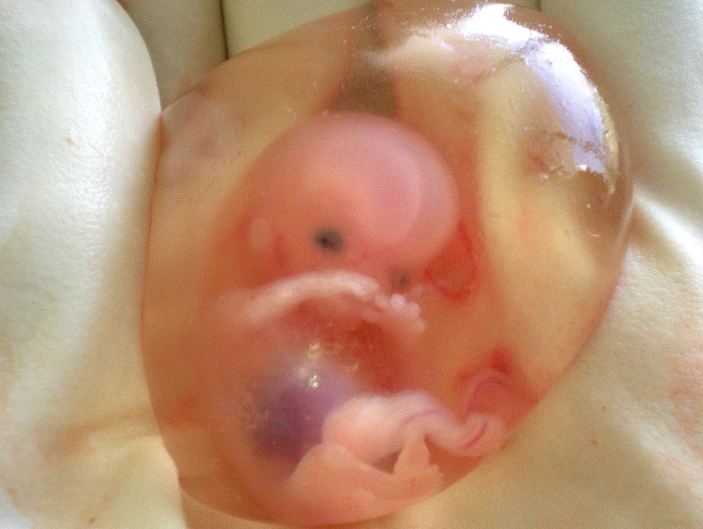 Human fetus at 10 weeks with amniotic sac - therapeutic abortion