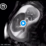 MRI Of Preborn Baby
