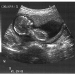 Fetus At Four Months